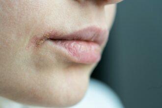 Closeup of sore woman dry lips affected by herpes, suffering from food allergy, infection or virus